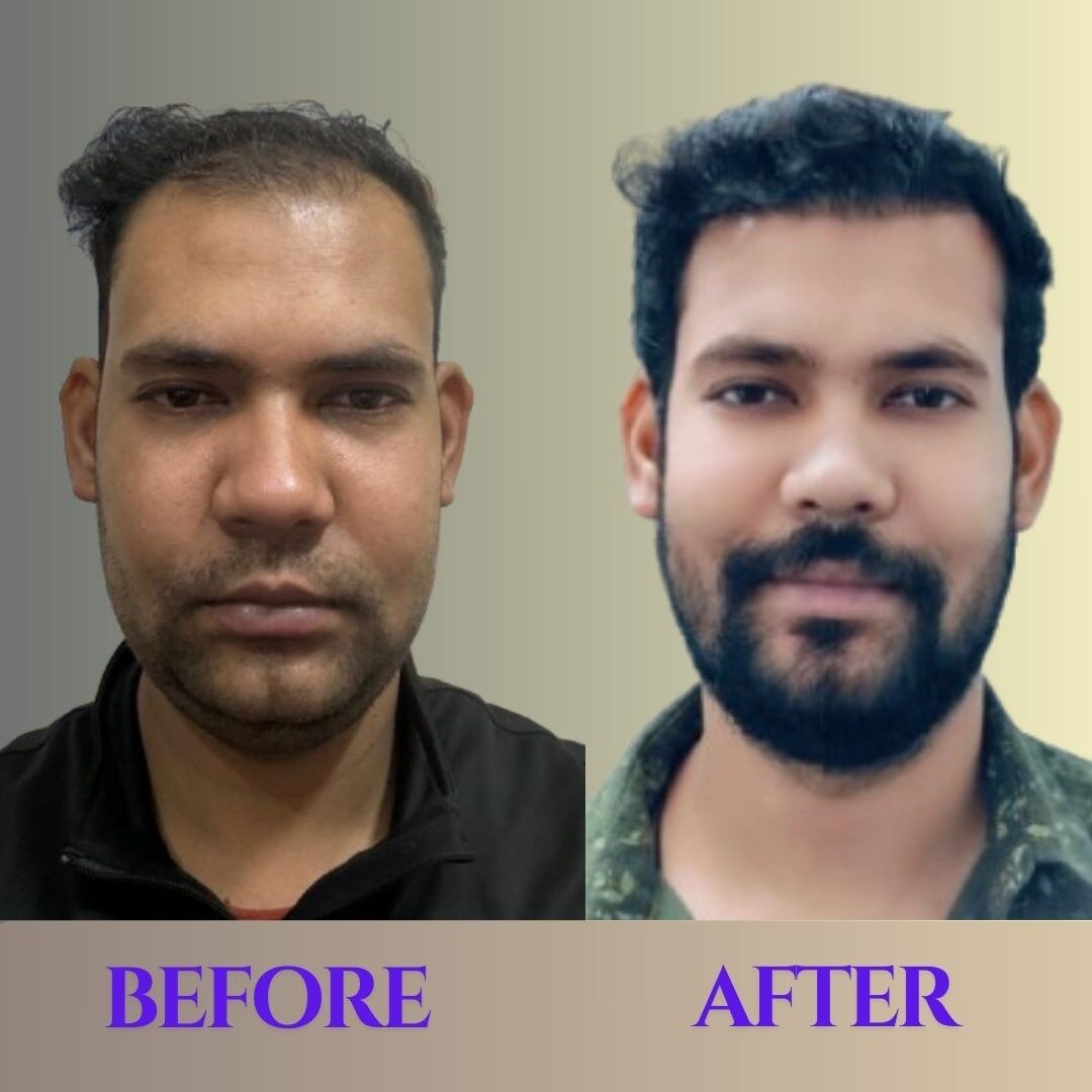 results hair transplant Before after hair transplant