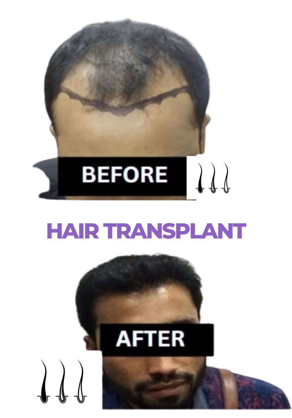 Before & After Hair Transplant Results Before & After Hair Transplant Results
