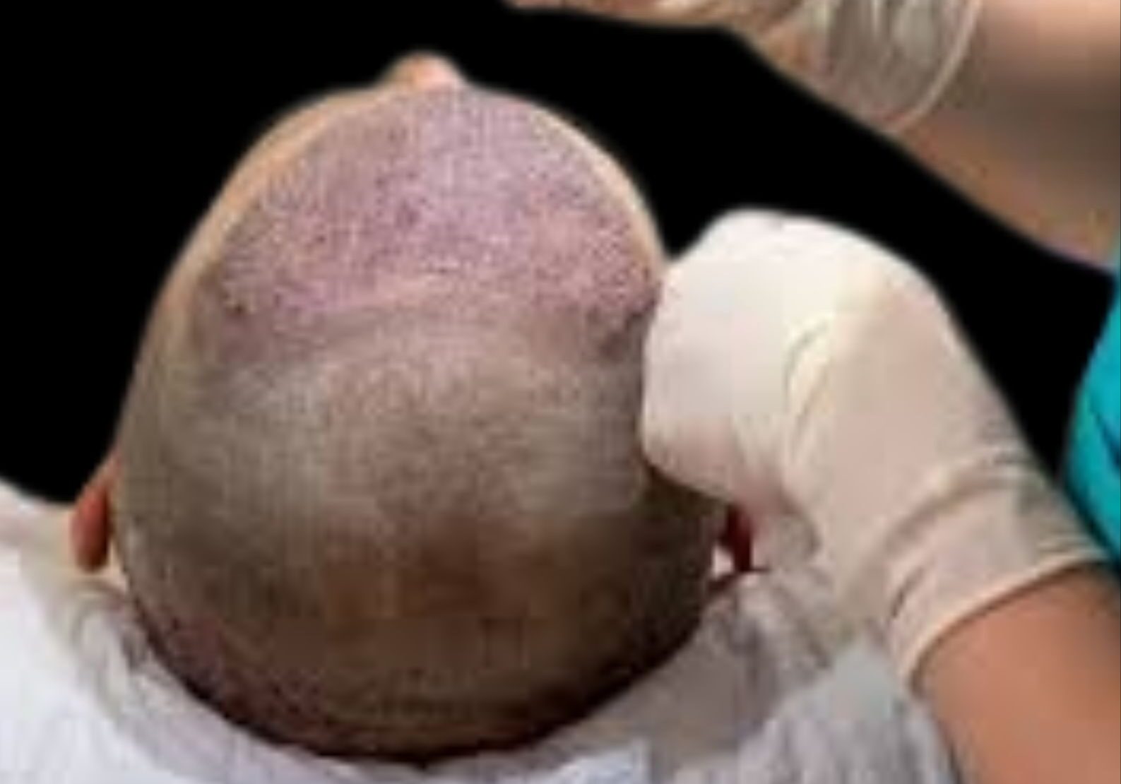 Hair restoration Hair restorations
