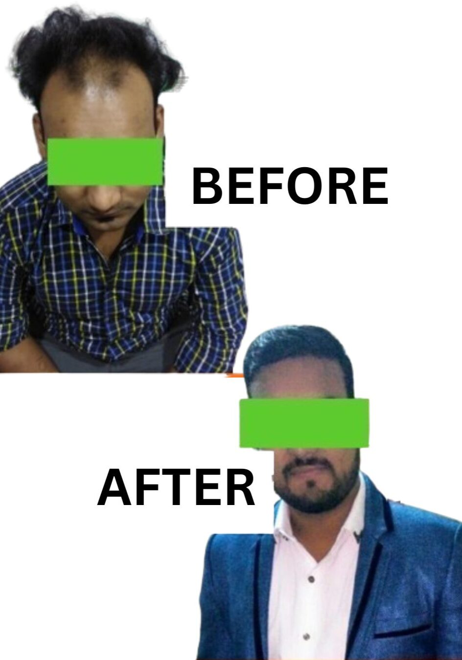 Before & After Hair Transplant Results Before & After Hair Transplant Results