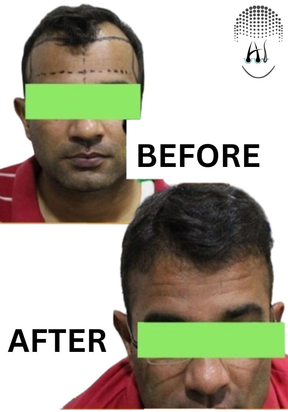 Before & After Hair Transplant Results Before & After Hair Transplant Results