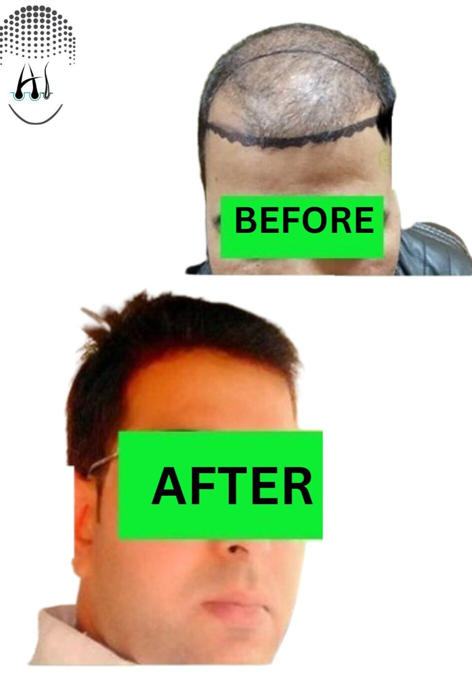 Before & After Hair Transplant Results Before & After Hair Transplant Results