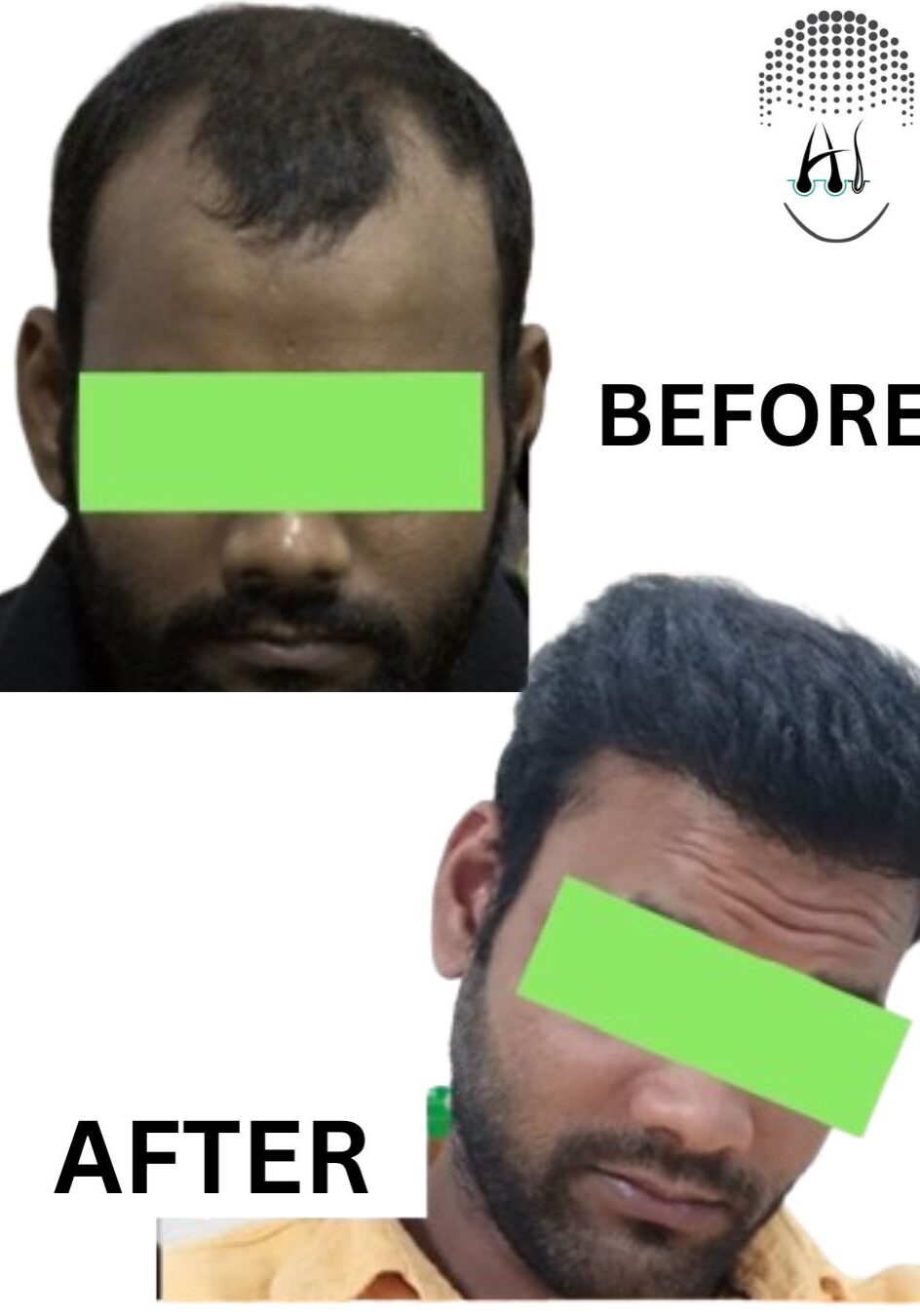 Before & After Hair Transplant Results Before & After Hair Transplant Results